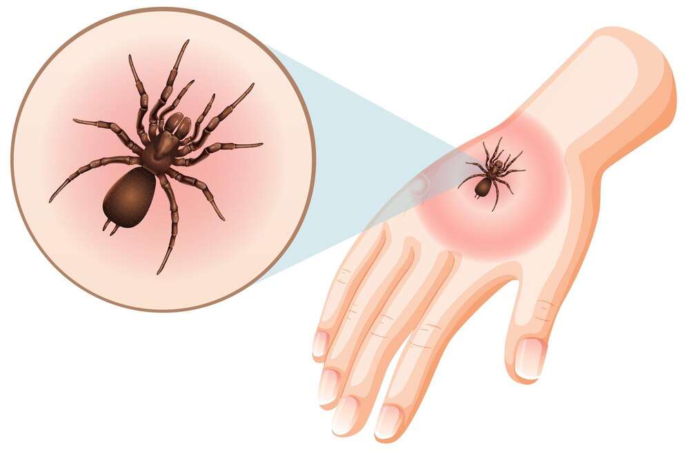 Top 10 Effective Treatments for Joro Spider Bite Symptoms – Proven Relief